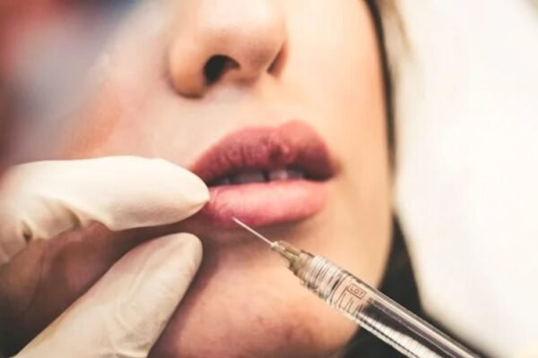 Lip Fillers