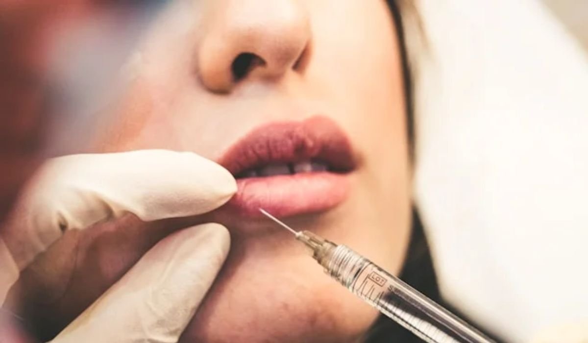 Lip Fillers